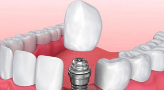 İmplant yapımı sonrası diş bakımına dikkat!