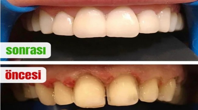 Dişte kelebek modası