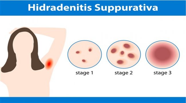 Köpek memesi hastalığının tedavisinde yüz güldürücü sonuçlar var
