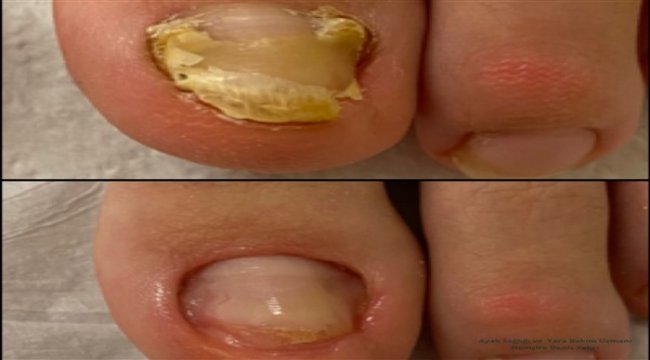 Mantar enfeksiyonu nedeniyle tırnaklarınızı kaybetmeyin